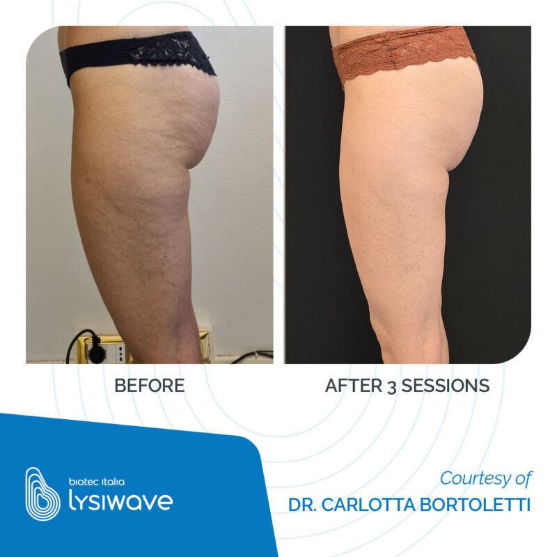 LYSIWAVE_Before-After_33-800x800