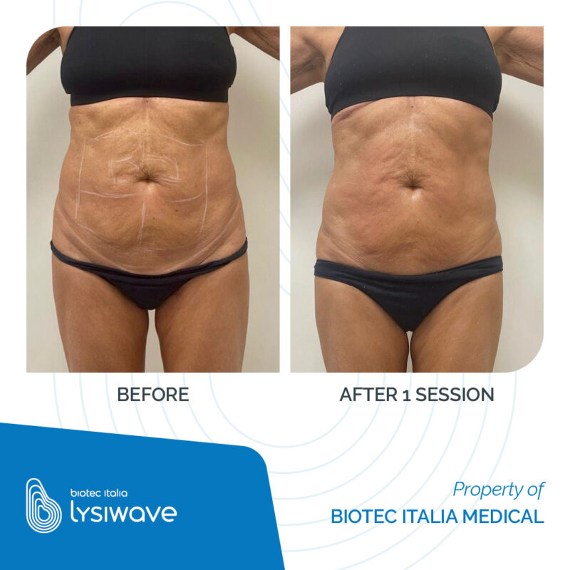 LYSIWAVE_Before-After_35-800x800