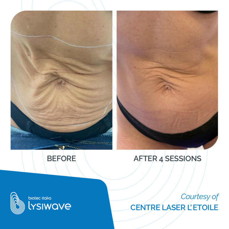 LYSIWAVE_Before-After_36-800x800